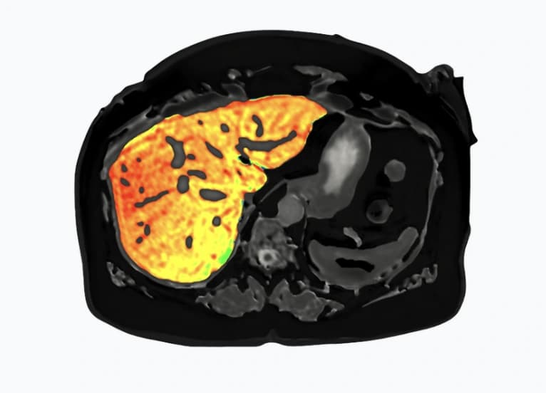 LiverMultiScan analysis visualization of liver fat fraction