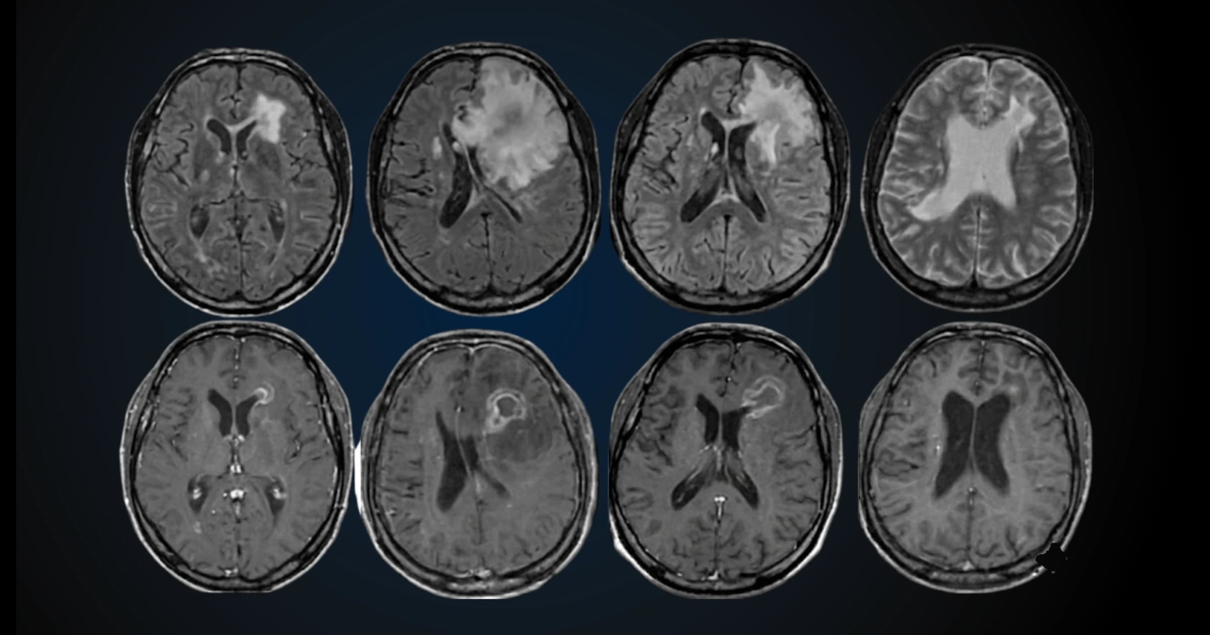 Brain Tumors Explained: A Practical Guide