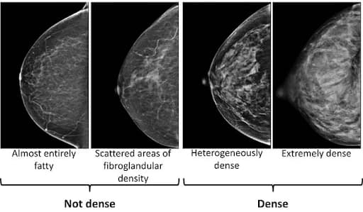 Breast density comparison