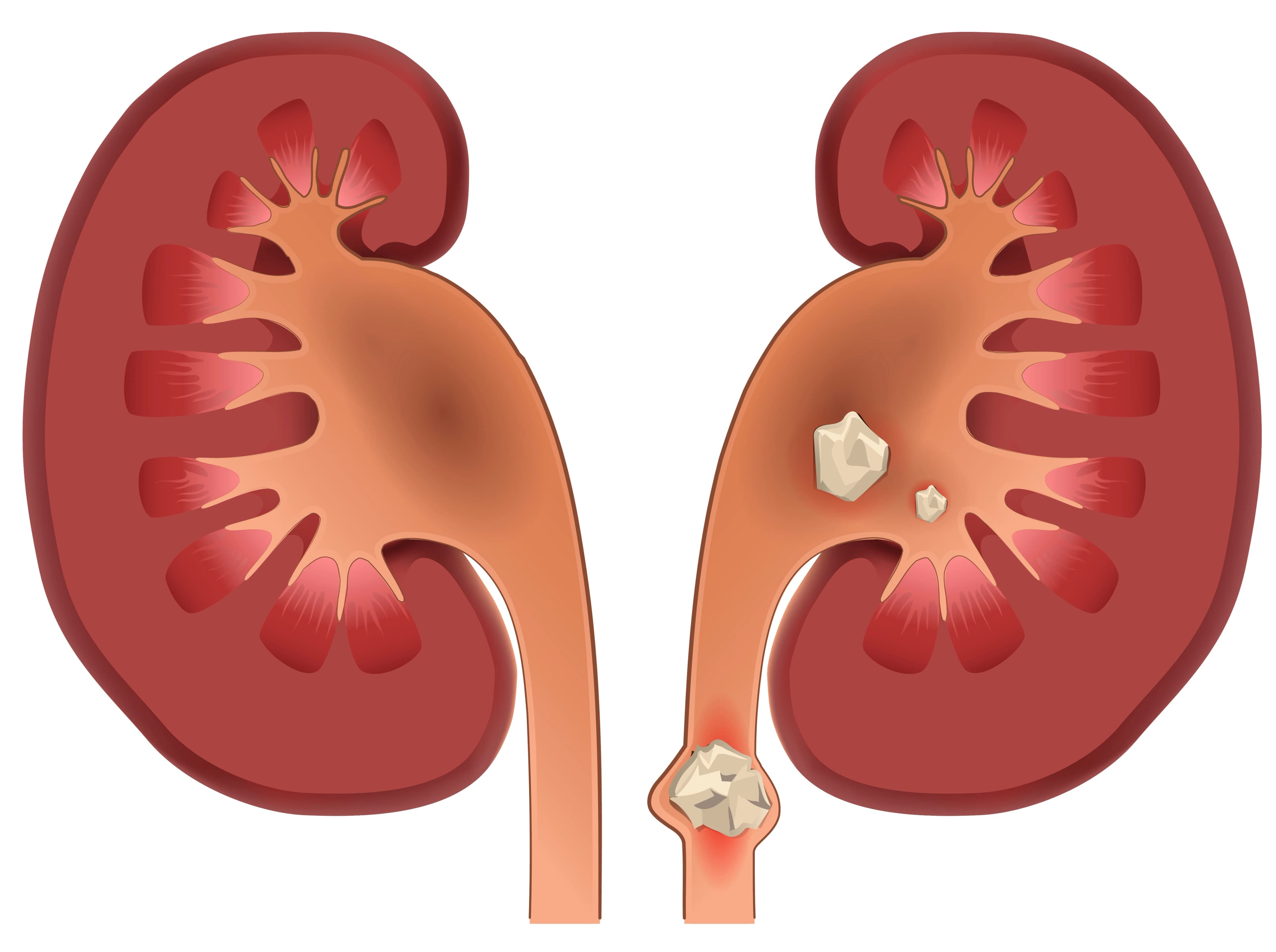 Kidney stone formation and anatomy