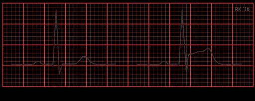 ECG ST Curve showing elevated vs normal ST segment