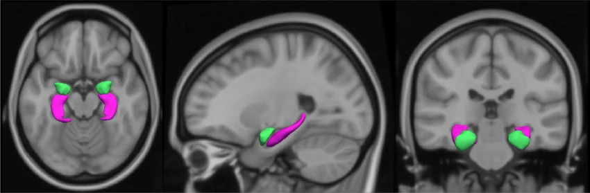 T1-weighted MRI scan showing the amygdala in axial, sagittal, and coronal view