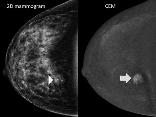 Standard mammogram vs contrast-enhanced mammogram