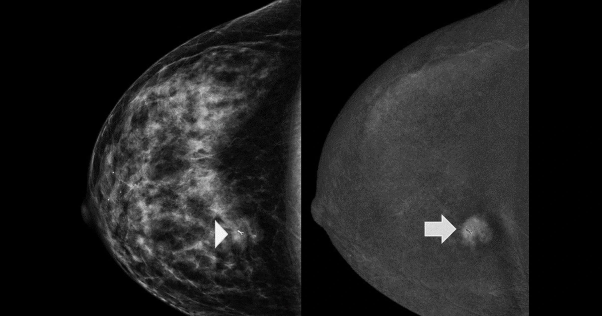 Your Mammogram is Searching for Cancer in a Blizzard