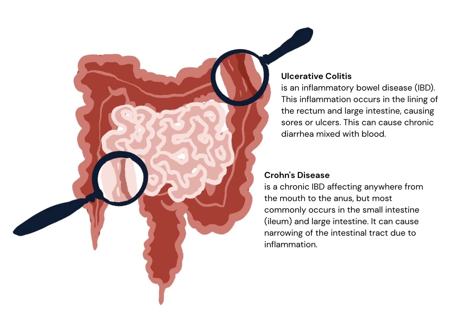 Gastrointestinal system anatomy and common areas affected by digestive disorders