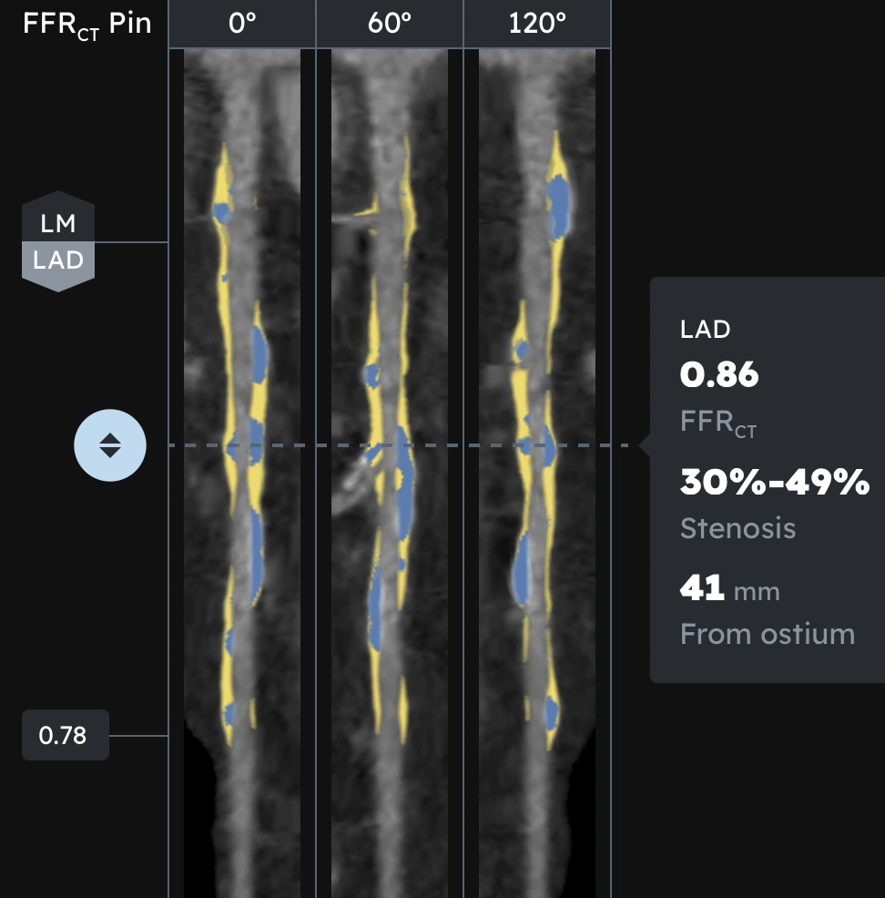 CCTA imaging of the Left Anterior Descending (LAD) coronary artery