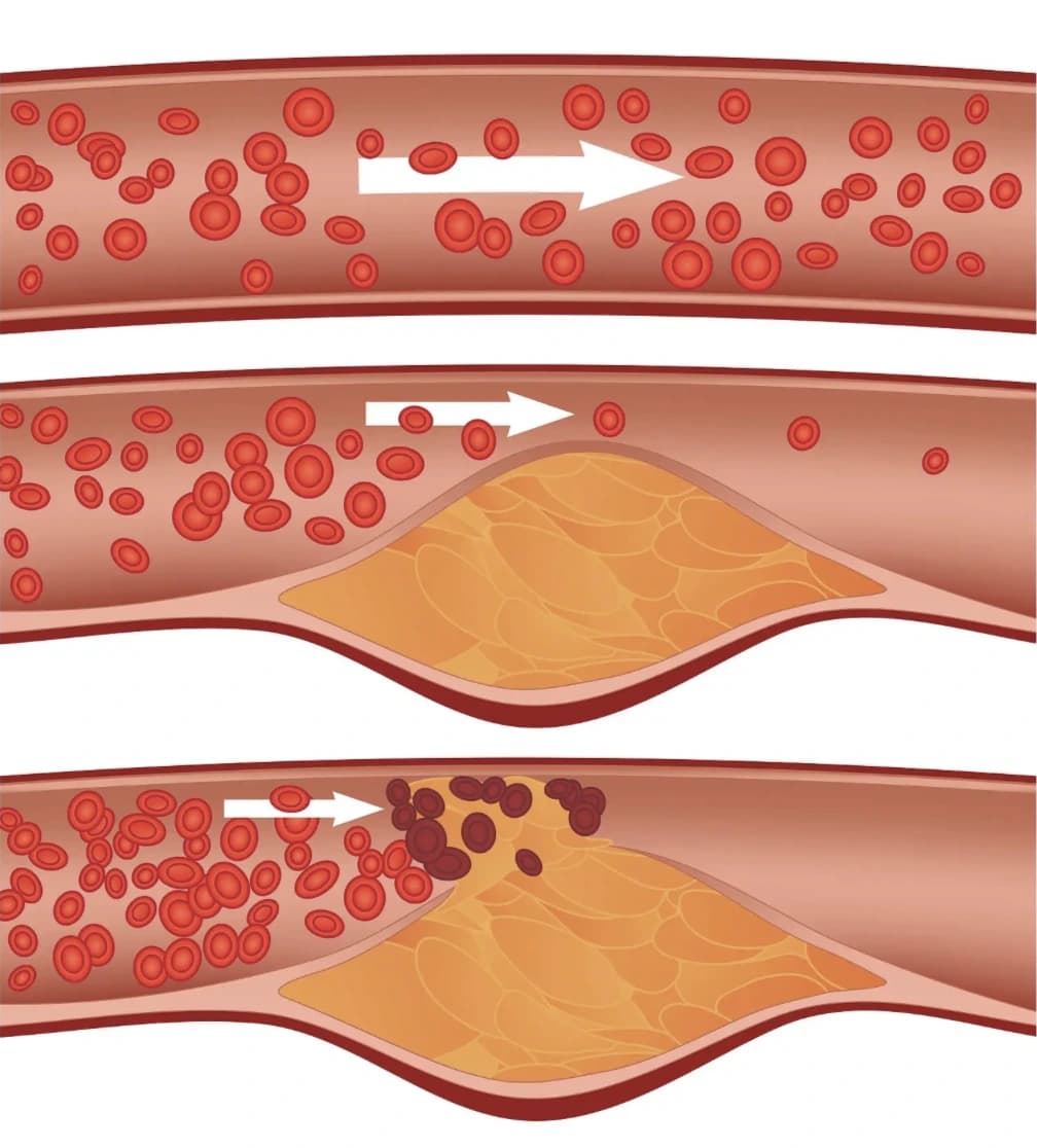 Illustration of ruptured soft plaque leading to total arterial blockage