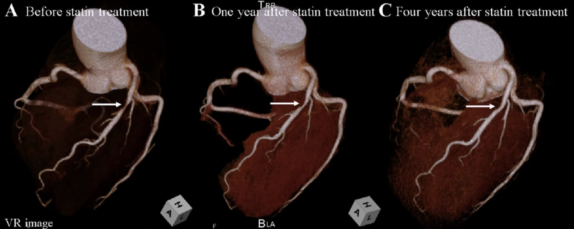 Before and after coronary plaque composition with lifestyle and medication